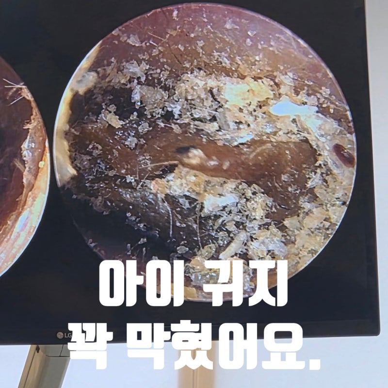 7세 아이 꽉 막힌 귀지｜귀지가 꽉 막혔을 때 이비인후과 다녀온 후기