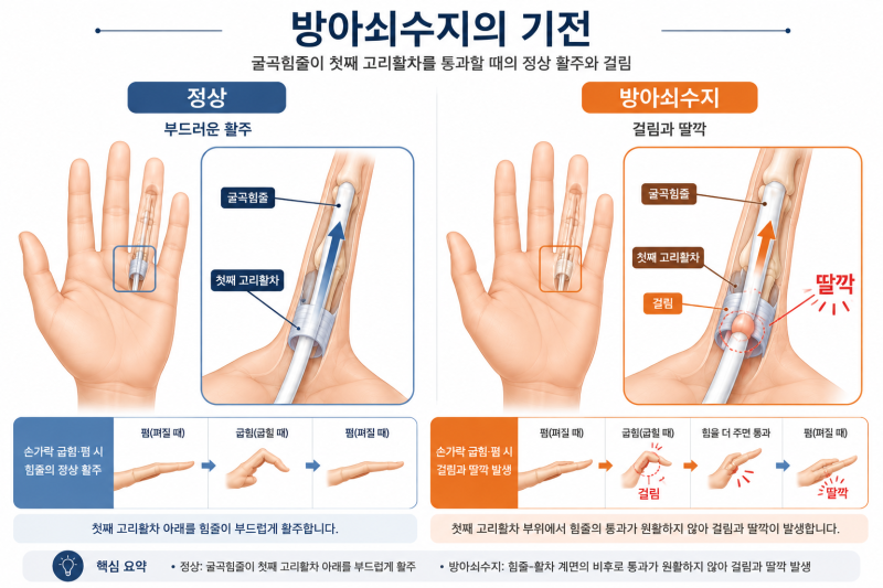 아침에 손가락이 딸깍하고 안 펴진다면? 방아쇠수지의 원인·증상·관리법
