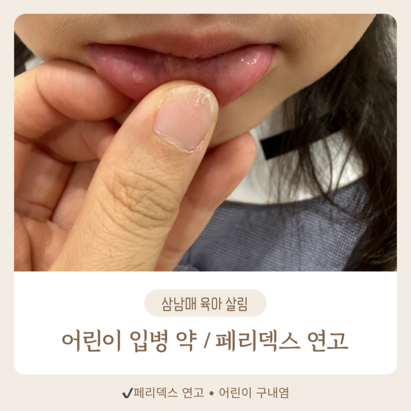 어린이 구내염·어린이 입병약 페리덱스 연고,바르면 아파할까?