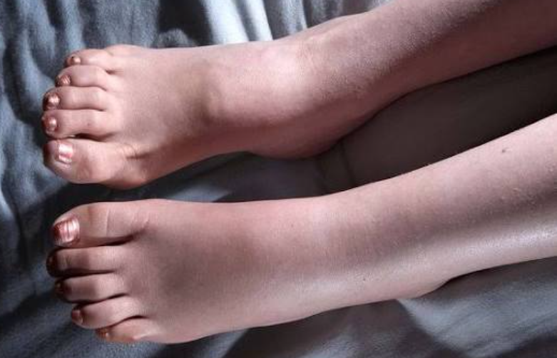 다리부종 원인 약 치료 병원