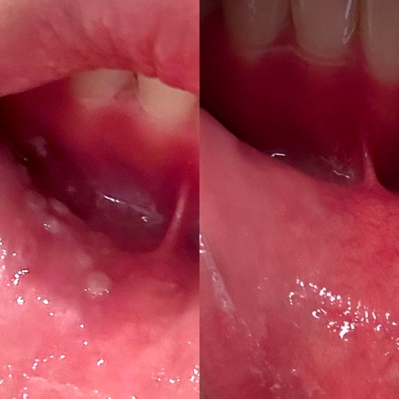 잇몸 염증에 알보칠 발랐다가 입술까지 번진 물집, 하루만에 가라앉는 약사님 pick 현실대처....