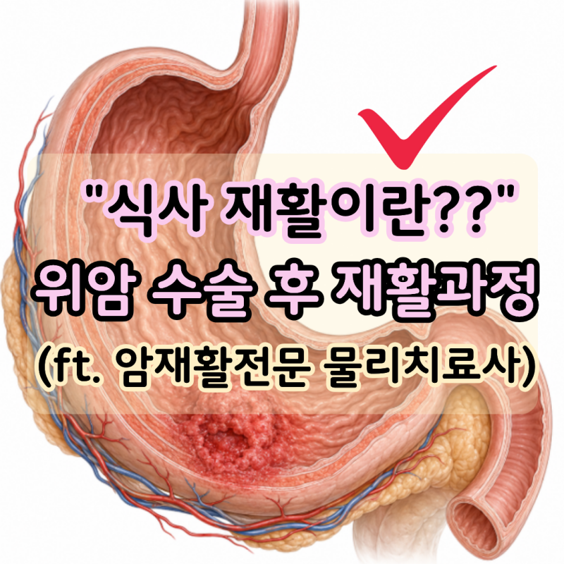 "위암 수술 후 재활?"위암 회복과 재활은 어떻게 진행될까?