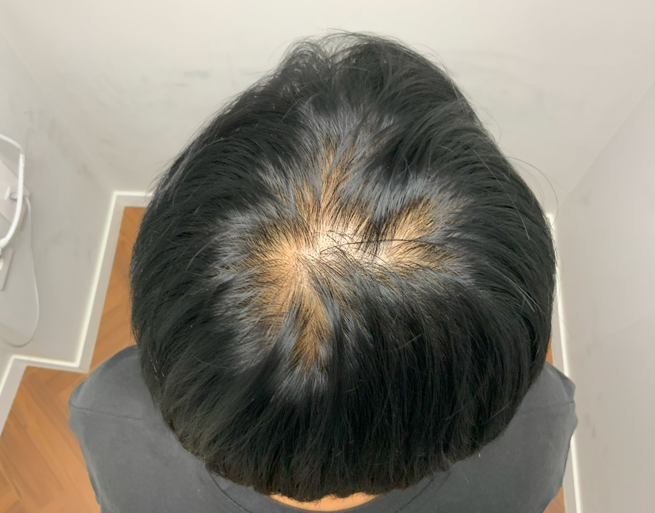 종로 탈모병원 5가 성지 탈모약 처방 후 치료 후기