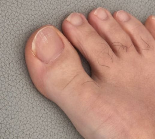 엄지발가락에 작은 물집이 반복된다면 한포진일까 무좀일까, 어떻게 구별할까?