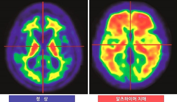 레켐비 치료비, 5천만원 든다고?