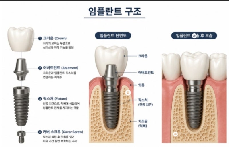 최근 임플란트 시술 중 사망 사고에 대한 관심이 커진 만큼, 특정 사건의 원인을 단정하기보....