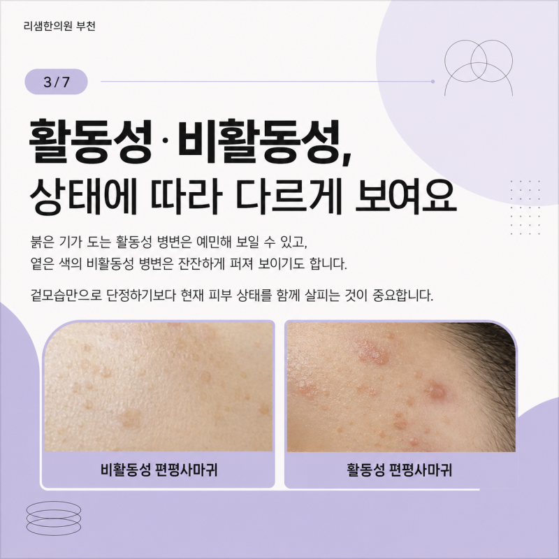 부천 편평사마귀, 1:1 여자 원장 세심하게 무제한 제거하는 리샘한의원!