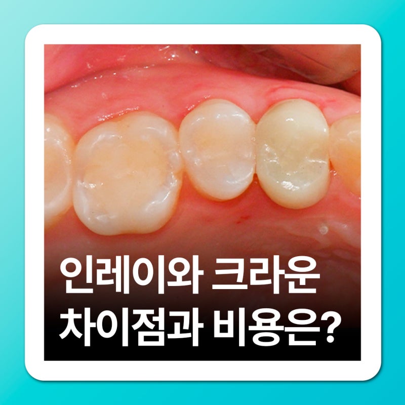 온천장치과 충치치료 인레이 크라운 비용, 차이점이 뭘까요?