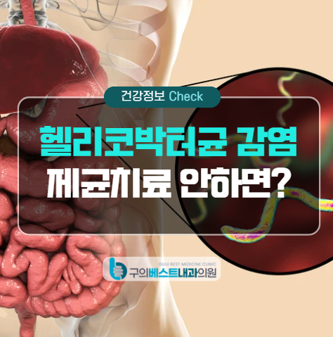 능동 위내시경, 헬리코박터균 제균 치료를 안 하면 어떻게 되나요?