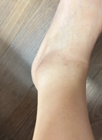 발목 통풍 증상 붓고 열감 느껴진다면