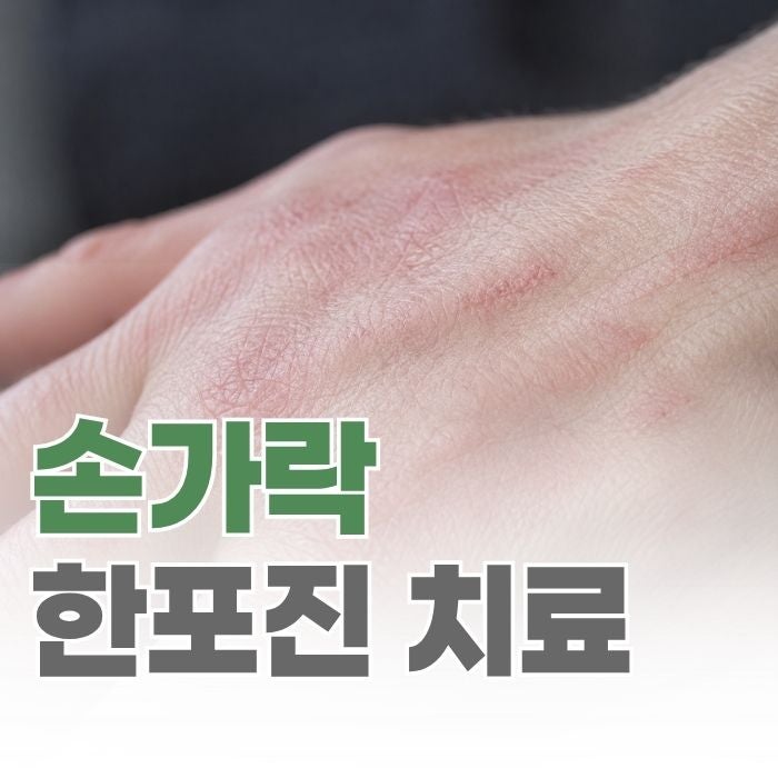 손가락 한포진 치료법, 연고만 바른다고 낫는 것이 아닙니다