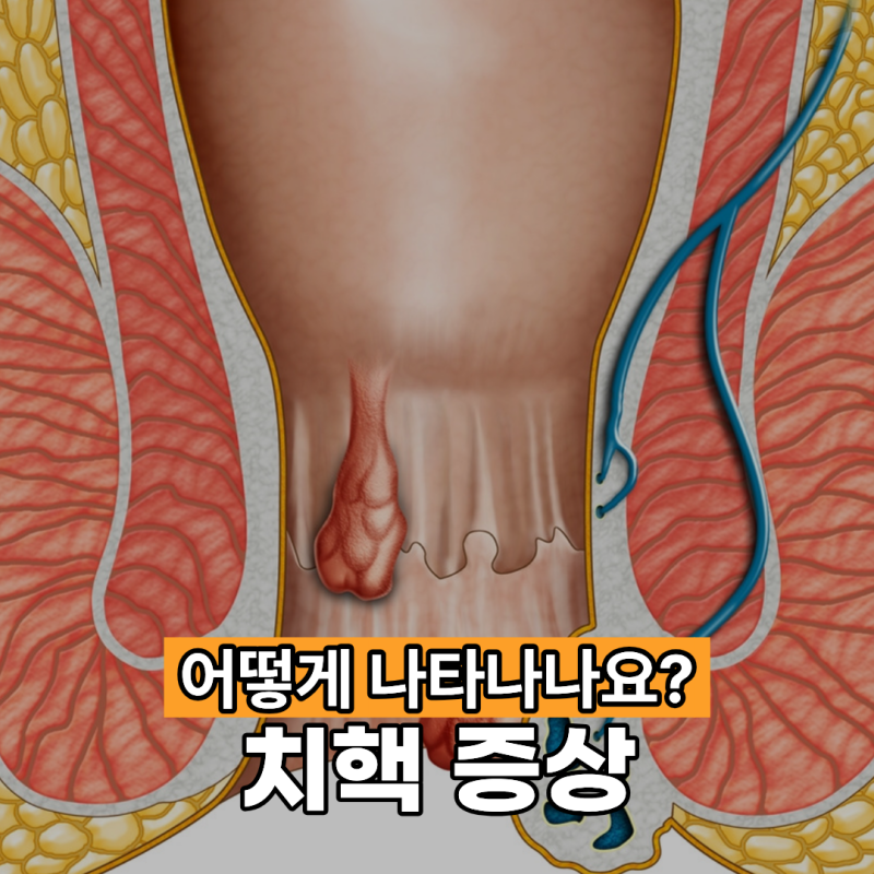 치핵 증상 어떻게 나타나나요?
