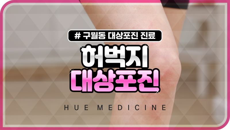 허벅지 안쪽 두드러기 통증 동반하는 대상포진 증상?