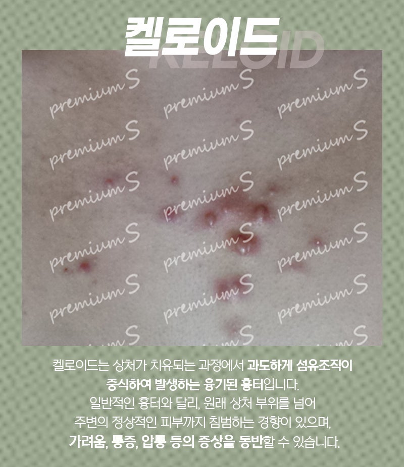 부산켈로이드의 검붉은 피부는 색소침착일까, 아니면 다른 이유일까?