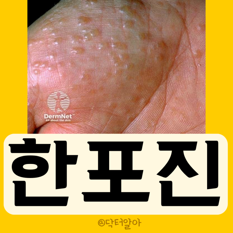 의사가 설명하는 한포진 정의 증상 원인 진단 치료 예방