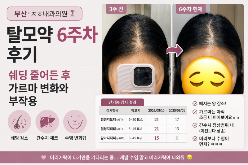 부산 ㅈㅎ내과의원 탈모약 6주차 후기 머리빠지는거 줄었는데 부작용이..!