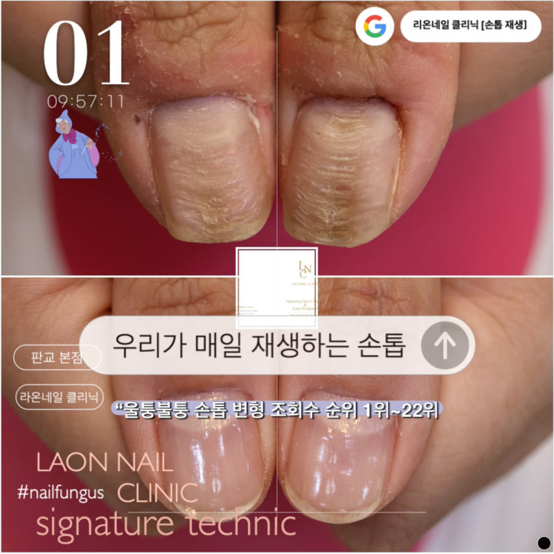 울퉁불퉁 두껍게 변형되며 자라는 손톱을 치료하려면?