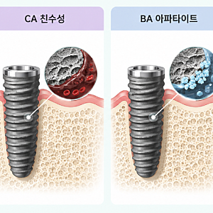 오스템 임플란트 등급별 차이, SA·CA·BA·SOI 선택 기준