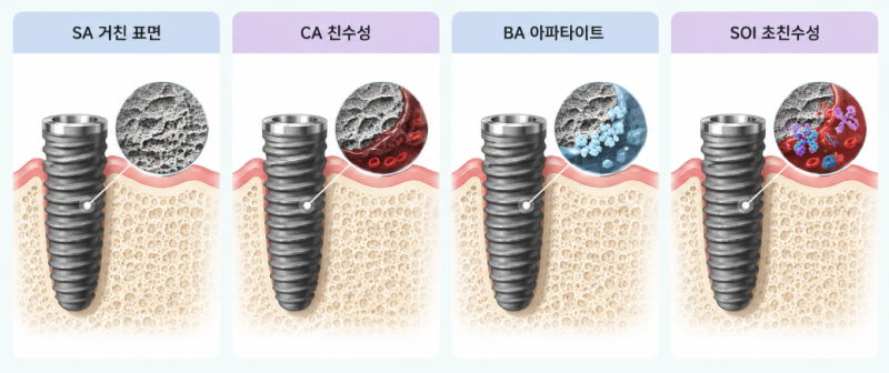 오스템 임플란트 등급별 차이, SA·CA·BA·SOI 선택 기준