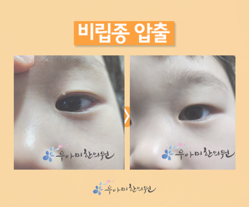 비립종 압출｜꺼낸 하얀 알갱이의 정체는 피지가 아닙니다