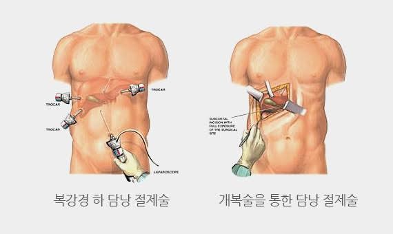 담낭 용종 제거 수술, 방법부터 회복까지 총정리