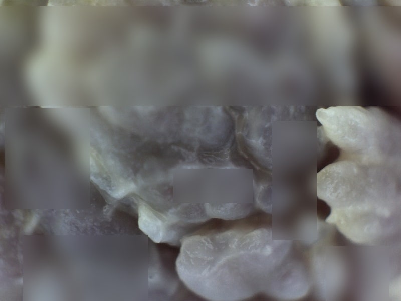 여자콘딜로마 잠복기 증상, 산부인과 레이저 제거 후 전염과 악화의 고리를 끊으려면?-항문....