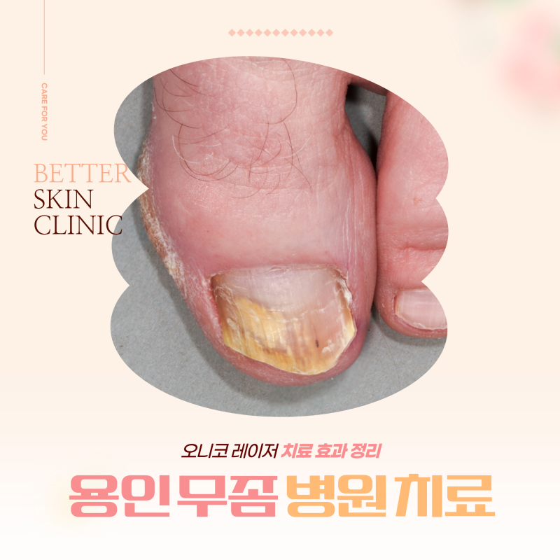용인 무좀 병원 오니코 레이저 치료 효과 정리