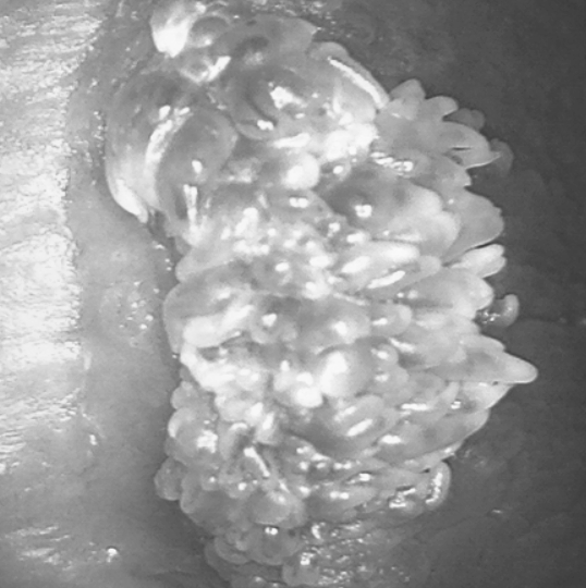 곤지름은 무조건 성병일까? HPV 감염 원인과 치료 방향 정리