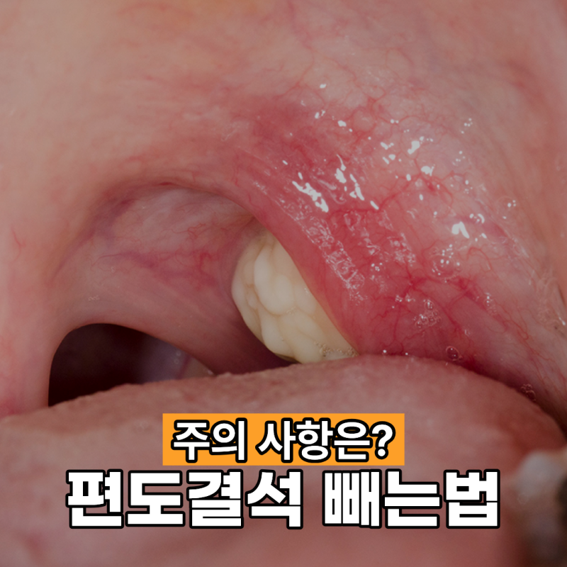 편도결석 빼는법 조심해야 할 사항은?