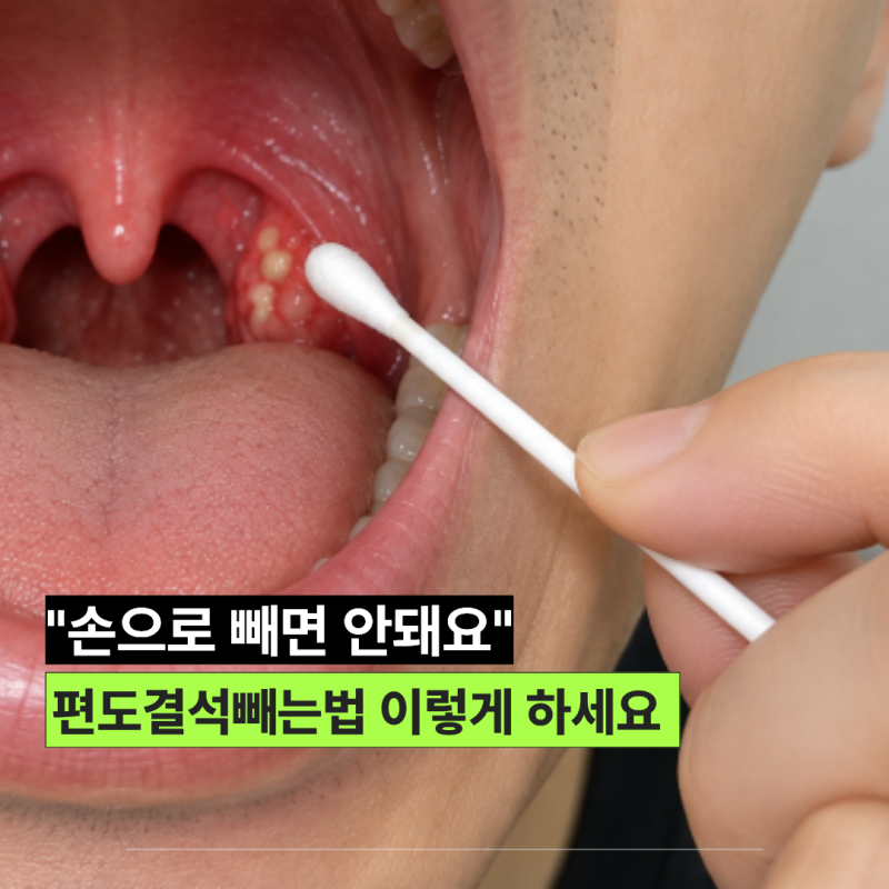 편도결석 빼는법 “손으로 빼면 안 됩니다” 원인과 주의할 점은?