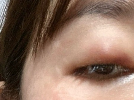콩다래끼 수술방법ㅣ 째는 과정부터 통증,회복까지 후기