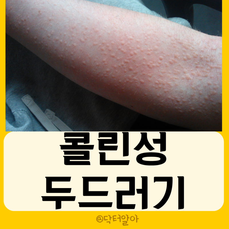 의사가 설명하는 콜린성두드러기 정의 증상 원인 진단 치료 예방