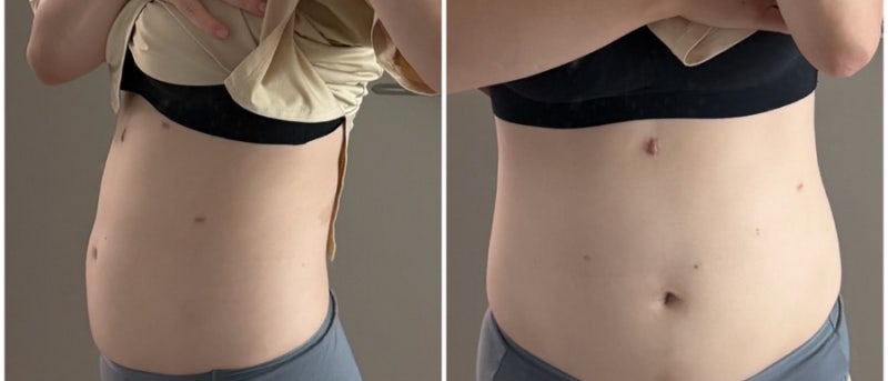 정상체중도 마운자로 효과 있을까? BMI 22 [3개월 -8kg]