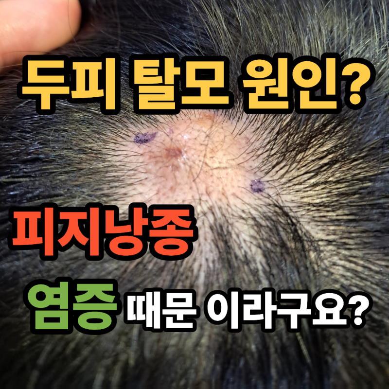 두피 탈모 원인이 피지낭종 염증때문이라구요?