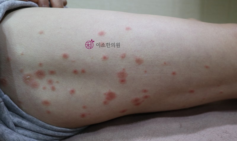 장미색비강진 vs 물방울 건선 vs 태선양비강진, 환절기 피부 발진 열꽃 주의사항