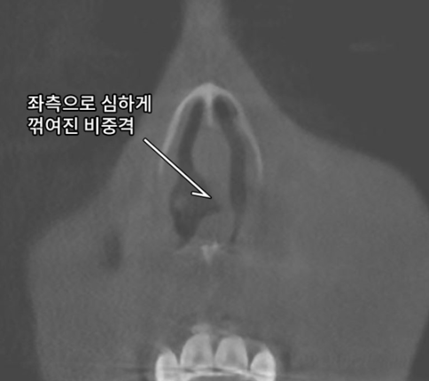 비염수술코성형 비중격만곡증 명의에게 받아야