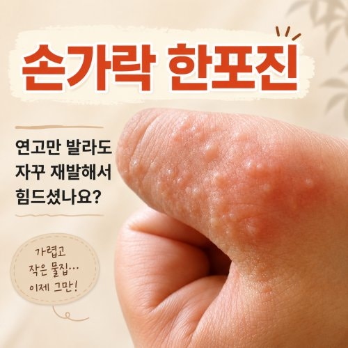 손가락 한포진 연고만 발라도 자꾸 재발해서 힘드셨나요?