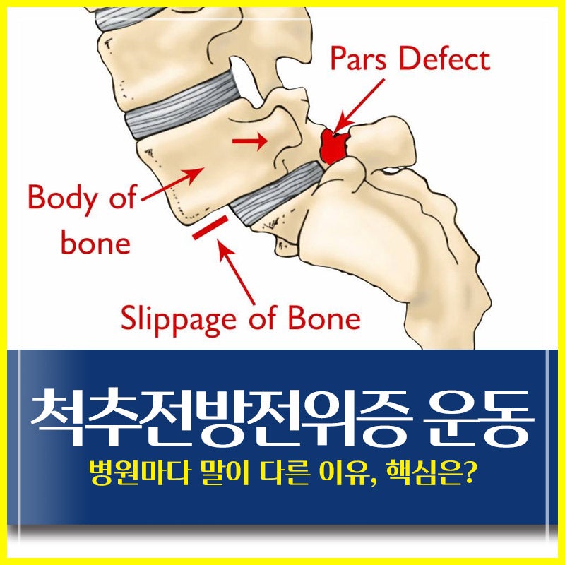 척추전방전위증 운동, 병원마다 말이 다른 이유, 핵심은?