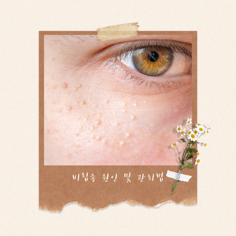 눈가에 오돌토돌한 알갱이, 비립종일까? 원인과 관리법
