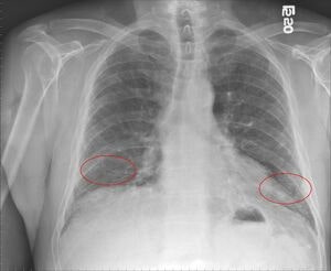 폐섬유화 Pulmonary fibrosis: 숨이 “당연한 것”이 아니게 되는 날