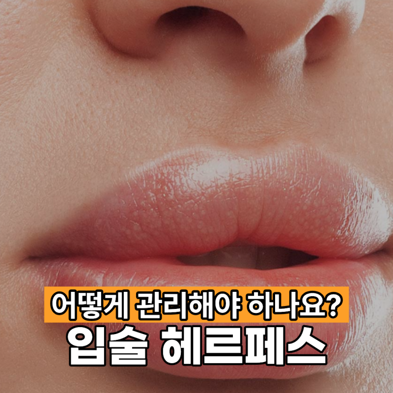 입술 헤르페스 어떻게 관리해야 하나요?