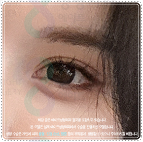 첫 쌍꺼풀 수술을 절개로 하고 눈 재수술은 매몰법(자연유착)으로 못하나? 비용 붓기는?
