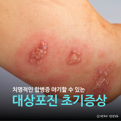 대상포진 초기증상 원인 치료 전염 예방접종 총정리
