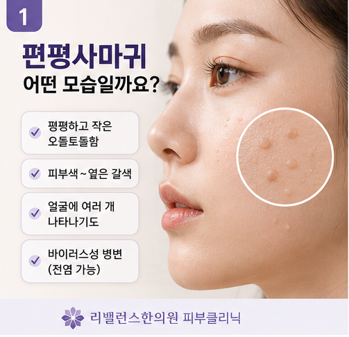 얼굴에 오돌토돌한 게 생겼어요, 편평사마귀·비립종·쥐젖·점 어떻게 다를까요?