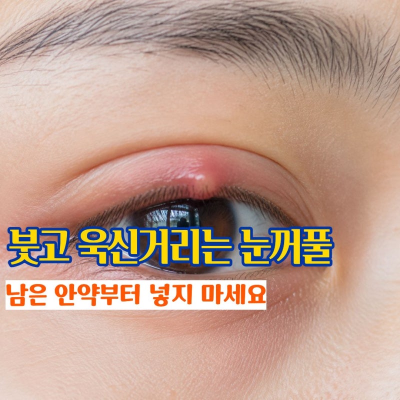 다래끼초기증상 눈꺼풀이 붓고 욱신거리는 다래끼나는이유와 다래끼전염과 치료