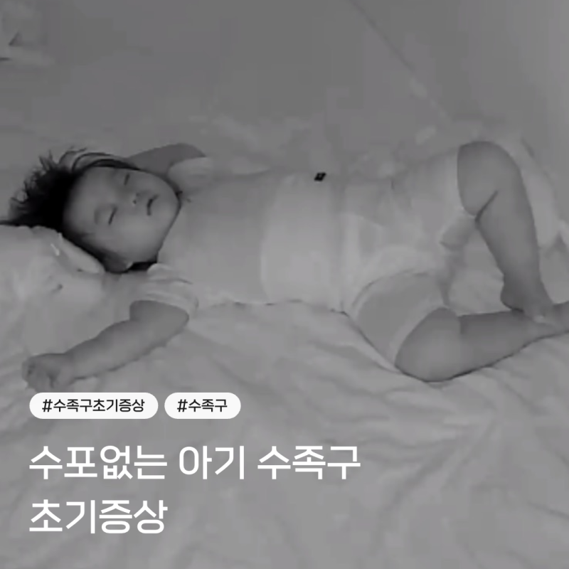아기 수족구 초기증상, 열 39도에 수포 없던 실제 사례 총정리