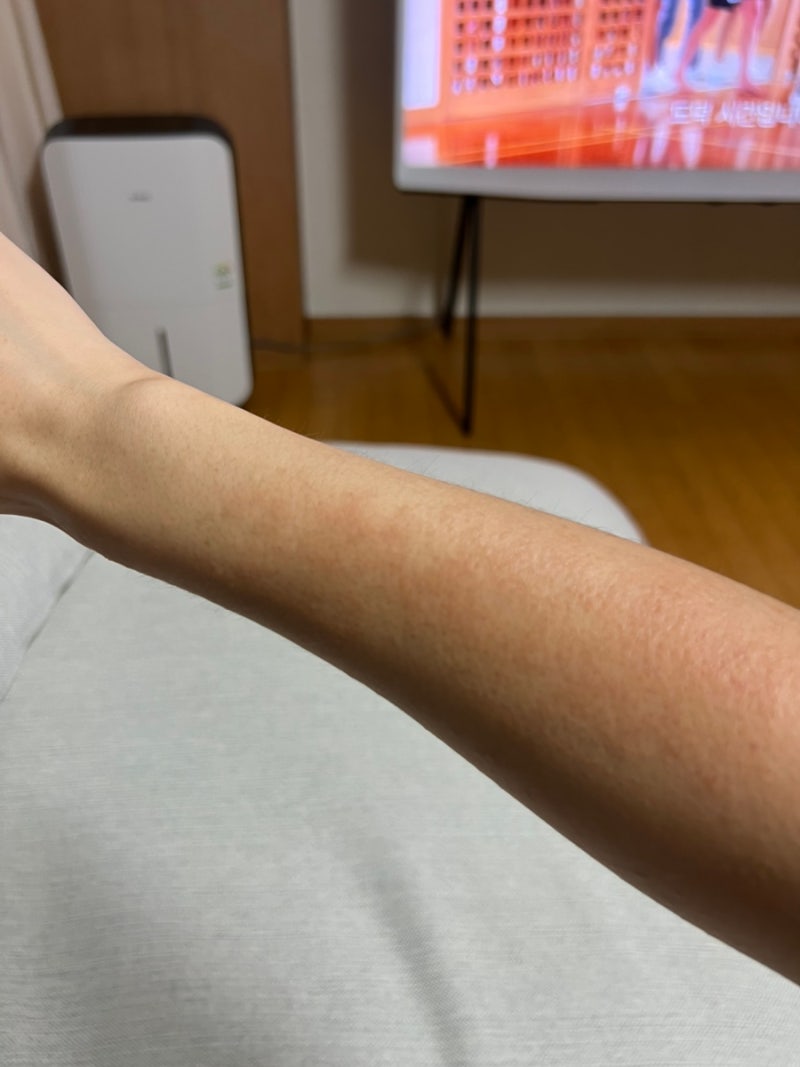 햇빛 알러지 또 재발… 국내여행도 방심하면 안 되는 이유ㅠㅠ 직접 겪은 햇빛 두드러기 후....