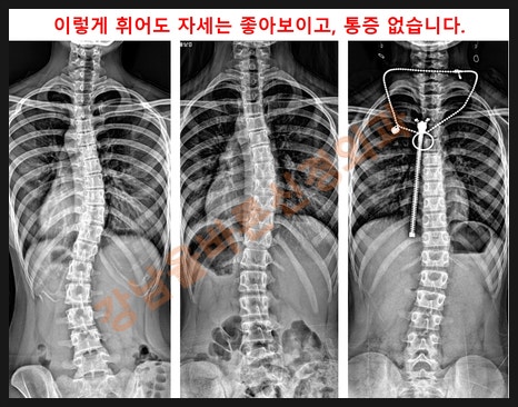 초등학생 척추측만증(척추옆굽음증) 교정기에 대한 진실