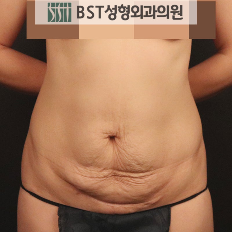 출산배빼는법, 수술로 해결한 사례