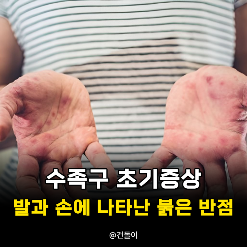 수족구 초기증상 발과 손에 나타난 붉은 반점이 핵심
